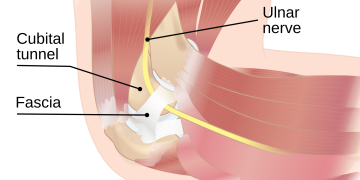 Cubital Tunnel Syndrome